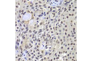 Immunohistochemistry of paraffin-embedded human well-differentiated squamous skin carcinoma using PRKDC antibody (ABIN5975861) at dilution of 1/100 (40x lens).