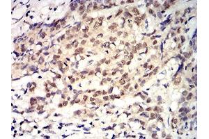 Immunohistochemical analysis of paraffin-embedded breast cancer tissues using ROP1 mouse mAb with DAB staining. (ROP1 (AA 42-183) antibody)
