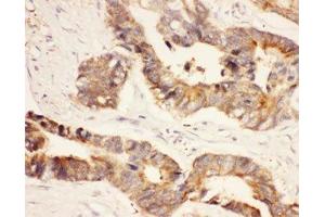 IHC-P: HSP90 antibody testing of human intestinal cancer tissue