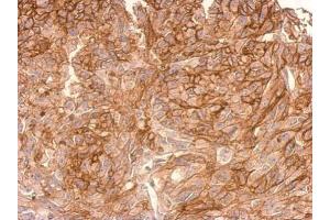 IHC-P Image ADAMTSL2 antibody [C3], C-term detects ADAMTSL2 protein at cytosol(secreted) on SkHep1xenograft by immunohistochemical analysis. (ADAMTSL2 antibody  (C-Term))