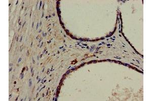 Immunohistochemistry of paraffin-embedded human prostate cancer using ABIN7150279 at dilution of 1:100 (ERCC4 antibody  (AA 656-753))