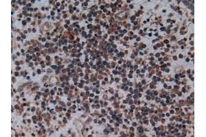 Detection of C2CD3 in Human Skin cancer Tissue using Polyclonal Antibody to C2 Calcium Dependent Domain Containing Protein 3 (C2CD3) (C2CD3 antibody  (AA 1432-1647))