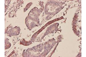 Immunoperoxidase of monoclonal antibody to SAA1 on formalin-fixed paraffin-embedded human colon adenocarcinoma tissue. (SAA1 antibody  (AA 1-122))