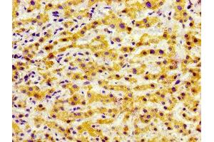 Immunohistochemistry of paraffin-embedded human liver cancer using ABIN7153297 at dilution of 1:100 (GRK5 antibody  (AA 406-590))