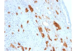 Formalin-fixed, paraffin-embedded human Mesothelioma stained with Calretinin Mouse Monoclonal Antibody (CALB2/2807).