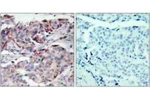 Immunohistochemistry analysis of paraffin-embedded human breast carcinoma, using JAK2 (Phospho-Tyr221) Antibody.