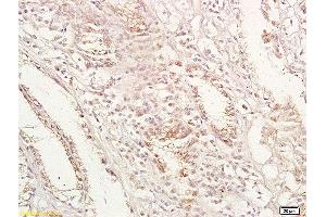 Formalin-fixed and paraffin embedded human gastric carcinoma labeled with Anti-GPA33 Polyclonal Antibody, Unconjugated (ABIN673644) at 1:200 followed by conjugation to the secondary antibody and DAB staining. (GPA33 antibody  (AA 151-280))