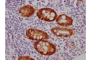 IHC image of ABIN7127518 diluted at 1:100 and staining in paraffin-embedded human colon cancer performed on a Leica BondTM system. (Recombinant GPA33 antibody)