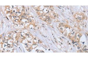 Immunohistochemistry of paraffin-embedded Human breast cancer tissue using PTPN4 Polyclonal Antibody at dilution 1:40 (PTPN4 antibody)