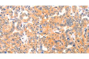 Immunohistochemistry of paraffin-embedded Human thyroid cancer tissue using THBS1 Polyclonal Antibody at dilution 1:60 (Thrombospondin 1 antibody)