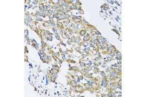 Immunohistochemistry of paraffin-embedded human lung cancer using SLC25A13 antibody. (slc25a13 antibody  (AA 1-300))
