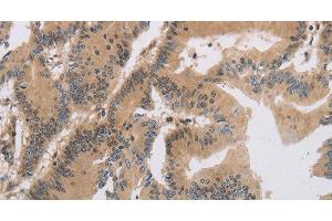 Immunohistochemistry of paraffin-embedded Human colon cancer tissue using ITIH1 Polyclonal Antibody at dilution of 1:30 (ITIH1 antibody)