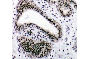 IHC-P: NRF1 antibody testing of human breast cancer tissue (NRF1 antibody  (Middle Region))