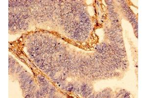 Immunohistochemistry of paraffin-embedded human colon cancer using ABIN7175699 at dilution of 1:100 (WDFY3 antibody  (AA 1-100))