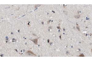 ABIN6272876 at 1/100 staining Human brain cancer tissue by IHC-P. (IFT81 antibody)