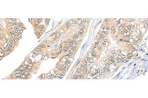 Immunohistochemistry of paraffin-embedded Human gastric cancer tissue using TBCB Polyclonal Antibody at dilution of 1:25(x200) (TBCB antibody)