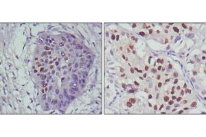 Immunohistochemical analysis of paraffin-embedded human esophageal cancer (left) and lung cancer (right), showing nuclear localization using p53 mouse mAb with DAB staining. (p53 antibody)