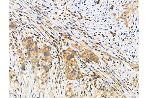 ABIN6257251 and ABIN6275164 at 1/100 staining Human ovarian cancer by IHC-P.