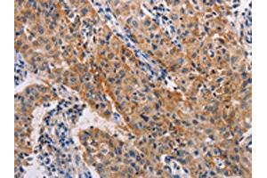 The image on the left is immunohistochemistry of paraffin-embedded Human lung cancer tissue using ABIN7128260(ADH1A Antibody) at dilution 1/20, on the right is treated with fusion protein. (ADH1A antibody)