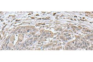Immunohistochemistry of paraffin-embedded Human esophagus cancer tissue using NEUROG3 Polyclonal Antibody at dilution of 1:70(x200) (Neurogenin 3 antibody)