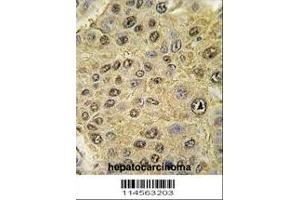Immunohistochemistry (Paraffin-embedded Sections) (IHC (p)) image for anti-Hypoxia Inducible Factor 1, alpha Subunit (Basic Helix-Loop-Helix Transcription Factor) (HIF1A) (AA 728-757), (C-Term) antibody (ABIN392176)