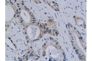 Formalin-fixed and paraffin embedded human colon labeled with Anti Styk1 Polyclonal Antibody, Unconjugated  followed by conjugation to the secondary antibody and DAB staining (STYK1 antibody  (AA 51-150))