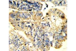 IHC analysis of FFPE human colon carcinoma stained with LIF antibody (LIF antibody  (AA 72-101))
