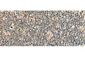 Immunohistochemistry of paraffin-embedded Human tonsil tissue using PRKRA Polyclonal Antibody at dilution of 1:65(x200) (PRKRA antibody)