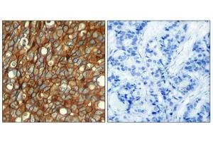Immunohistochemical analysis of paraffin-embedded human breast carcinoma tissue using HER2 (Phospho-Tyr1248) Antibody (left) or the same antibody preincubated with blocking peptide (right).