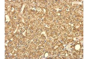 IHC-P Image SUCLG2 antibody detects SUCLG2 protein at cytosol on human hepatoma by immunohistochemical analysis. (SUCLG2 antibody)