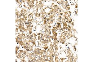 Immunohistochemistry of paraffin-embedded human liver cancer using Smad9 Rabbit pAb (ABIN6132668, ABIN6148096, ABIN6148097 and ABIN6223425) at dilution of 1:100 (40x lens). (SMAD9 antibody  (AA 1-300))