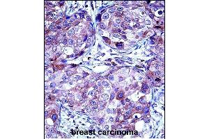 P13 Antibody (Center) (ABIN657629 and ABIN2846625) iunohistochemistry analysis in formalin fixed and paraffin embedded human breast carcinoma followed by peroxidase conjugation of the secondary antibody and DAB staining. (MMP13 antibody  (AA 253-282))