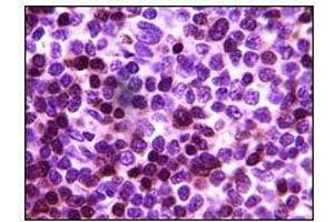 Immunohistochemical analysis of paraffin-embedded human lymph tumor, showing cytoplasmic localization using ZAP70 mouse mAb with DAB staining (ZAP70 antibody)