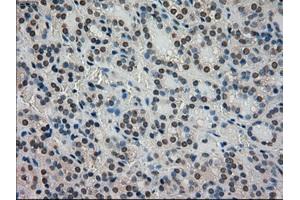 Immunohistochemical staining of paraffin-embedded Carcinoma of thyroid tissue using anti-STK39mouse monoclonal antibody. (STK39 antibody)