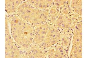Immunohistochemistry of paraffin-embedded human liver cancer using ABIN7170581 at dilution of 1:100 (SPHK1 antibody  (AA 1-384))