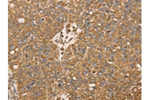 The image on the left is immunohistochemistry of paraffin-embedded Human breast cancer tissue using ABIN7130945(RRBP1 Antibody) at dilution 1/25, on the right is treated with fusion protein. (RRBP1 antibody)
