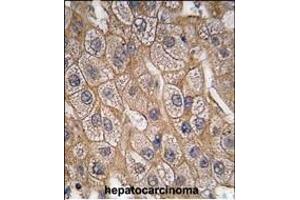 Formalin-fixed and paraffin-embedded human hepatocarcinoma tissue reacted with Endophilin B1 Antibody (Y80) (ABIN392590 and ABIN2842121) , which was peroxidase-conjugated to the secondary antibody, followed by DAB staining. (SH3GLB1 antibody  (AA 59-86))