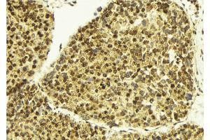 ABIN6273407 at 1/100 staining Human breast cancer tissue by IHC-P. (TSEN2 antibody  (Internal Region))