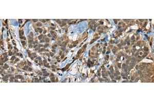 Immunohistochemistry of paraffin-embedded Human thyroid cancer tissue using CIR1 Polyclonal Antibody at dilution of 1:40(x200) (CIR1 antibody)