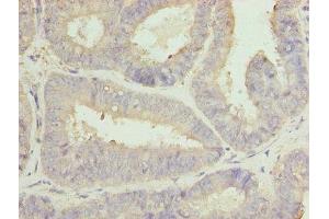 Immunohistochemistry of paraffin-embedded human endometrial cancer using ABIN7146467 at dilution of 1:100 (Calmegin antibody  (AA 200-400))