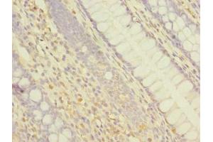 Immunohistochemistry of paraffin-embedded human colon cancer using ABIN7144926 at dilution of 1:100 (ABCF3 antibody  (AA 201-500))