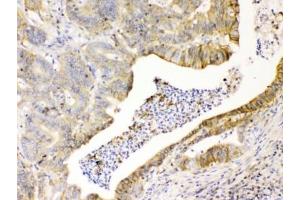 IHC testing of FFPE human intestinal cancer tissue with CD147 antibody at 1ug/ml.