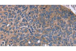 Immunohistochemistry of paraffin-embedded Human esophagus cancer tissue using RGS4 Polyclonal Antibody at dilution 1:30 (RGS4 antibody)