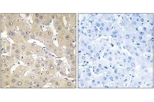 Immunohistochemistry analysis of paraffin-embedded human liver carcinoma tissue, using TNAP2 Antibody. (TNFAIP2 antibody  (AA 131-180))