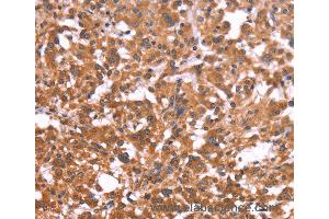Immunohistochemistry of Human colon cancer using CRISP3 Polyclonal Antibody at dilution of 1:50