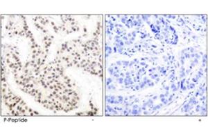 Immunohistochemical analysis of paraffin-embedded human breast carcinoma tissue using ELK1 (phospho T417) polyclonal antibody. (ELK1 antibody  (pThr417))