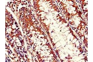 Immunohistochemistry of paraffin-embedded human colon cancer using ABIN7168038 at dilution of 1:100 (RHOH antibody  (AA 1-188))