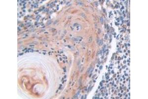 IHC-P analysis of Human Tissue, with DAB staining. (KRT6A antibody  (AA 163-468))
