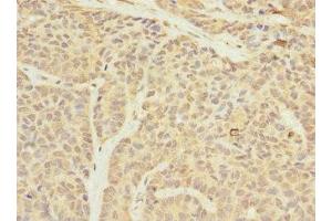 Immunohistochemistry of paraffin-embedded human ovarian cancer using ABIN7159905 at dilution of 1:100
