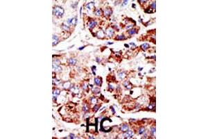 Formalin-fixed and paraffin-embedded human hepatocellular carcinoma tissue reacted with PIAS2 polyclonal antibody , which was peroxidase-conjugated to the secondary antibody, followed by DAB staining. (PIAS2 antibody  (C-Term))